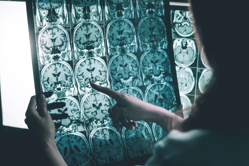 Farmaco per l’Alzheimer rallenta la malattia del 35%