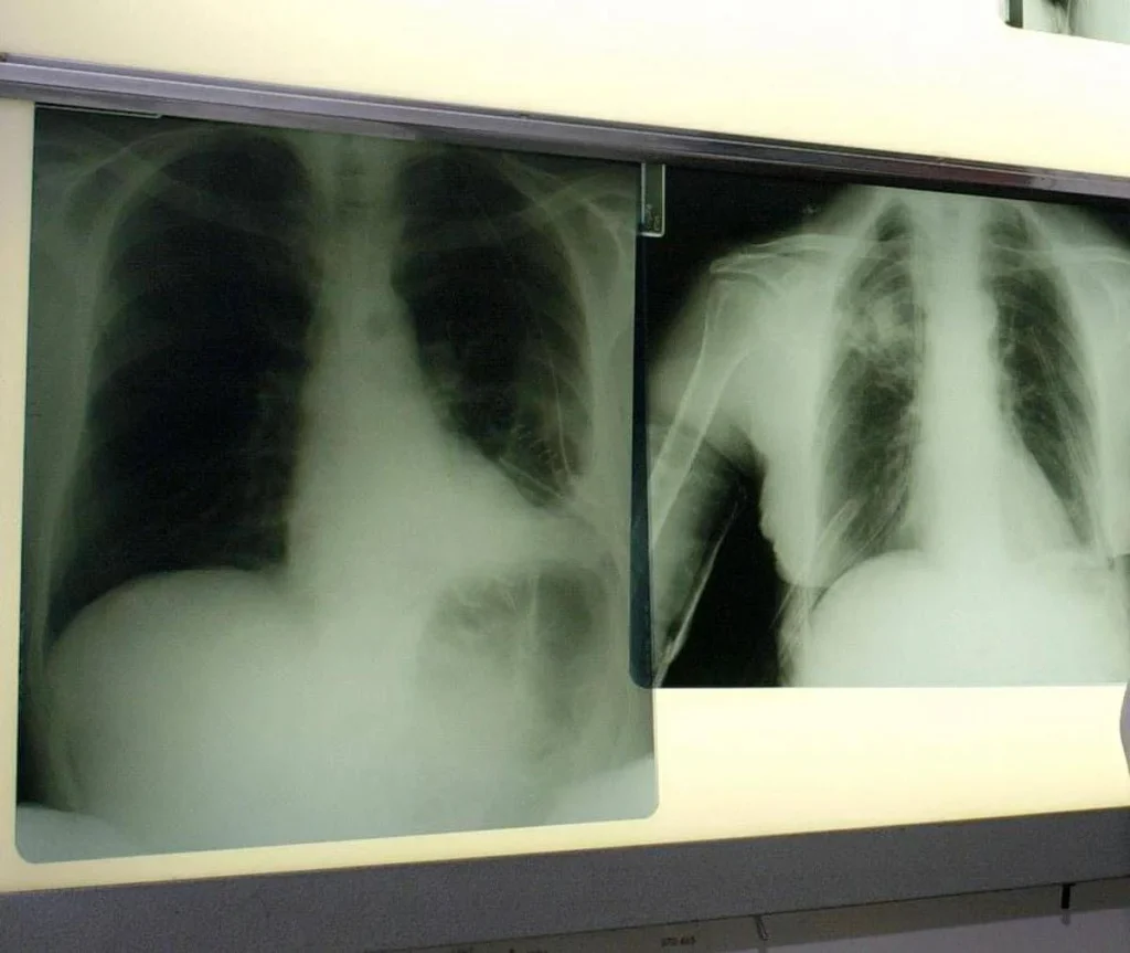 Cancro polmone, con nuova combinazione malattia sotto controllo più a lungo