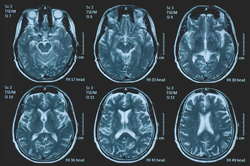 Una persona su 3 ha un disturbo neurologico, a Napoli arriva BrainSpace House
