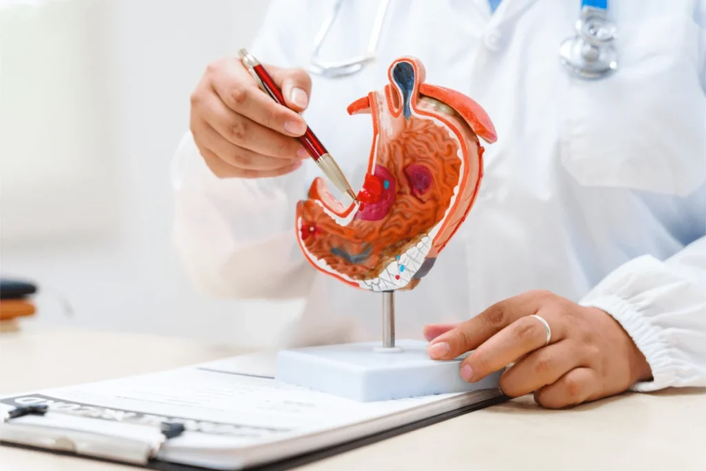 Cancro allo stomaco avanzato, nuova terapia riduce del 42% il rischio di morte 